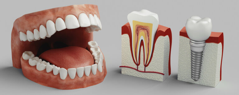 Implantate Minden