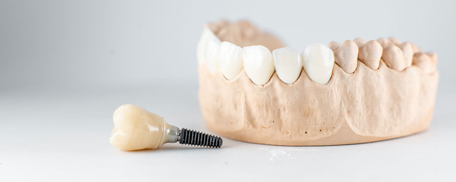 Implantologie in Wunstorf