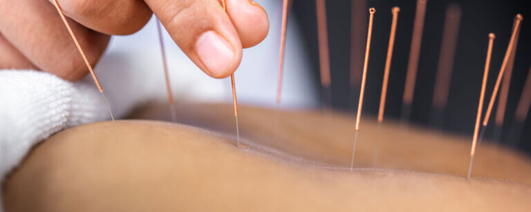 Akupunktur in Lingen